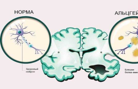 Study finds brain protein accumulation increases dementia risk fourfold